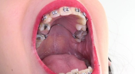 Brunette with dental braces opens wide for close up views of her big mouth